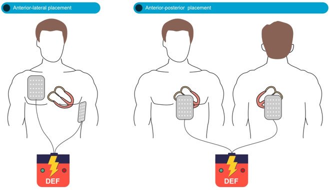 AED Pad Placement